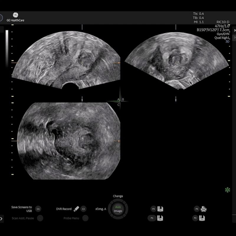 Fibroid Mapping 